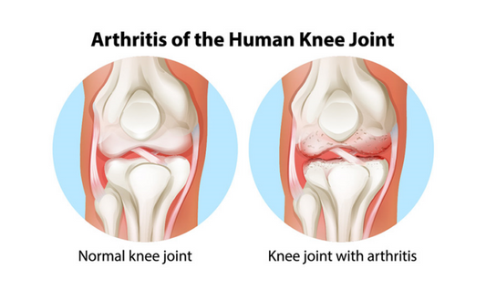 This is an informative post on arthritis of the human knee joint, showing two images of the knee skeleton for information purposes. 